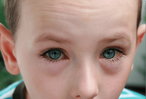 What Parents Need to Know About Pinkeye