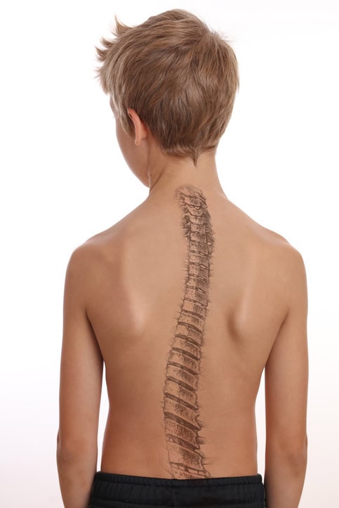 Scoliosis Spine Curve Anatomy, Posture Correction. Chiropractic treatment, Back pain relief.